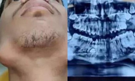 बिहार में डॉक्टरों ने दुर्लभ ट्यूमर वाले किशोर के 82 दांत निकाले