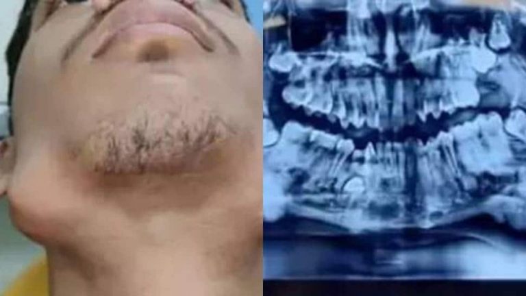 बिहार में डॉक्टरों ने दुर्लभ ट्यूमर वाले किशोर के 82 दांत निकाले