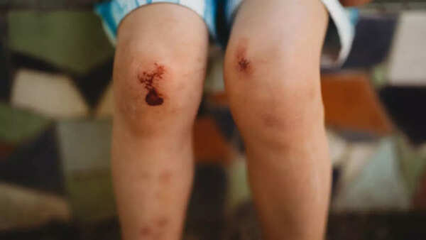 शरीर की चोट और रक्तस्राव अधिक तेजी से