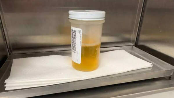 गहरे रंग का मूत्र और पेल स्टूल