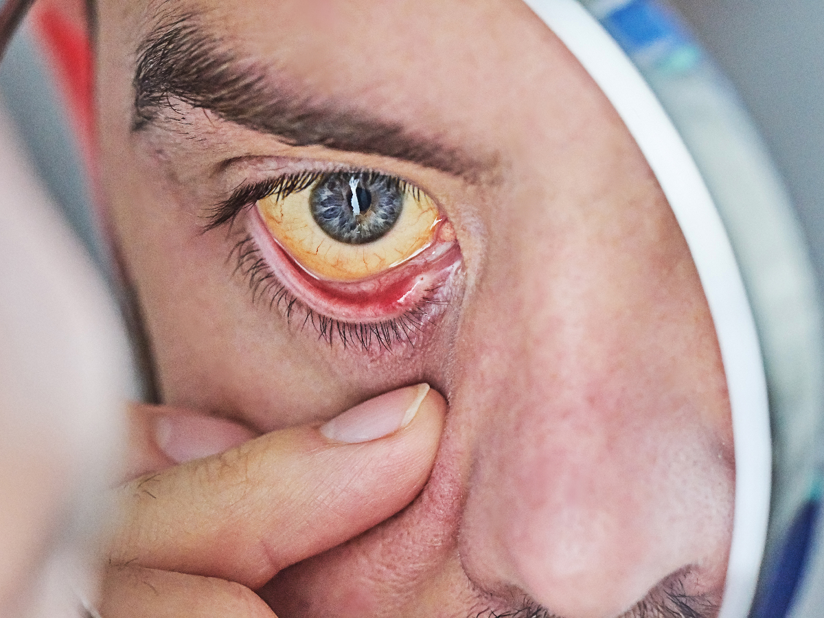 पीली आँखें