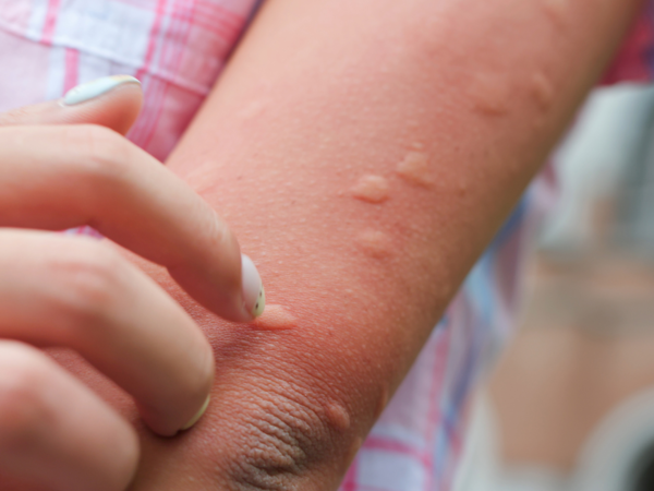 यात्रा या मानसून के मौसम के दौरान मच्छर काटता है