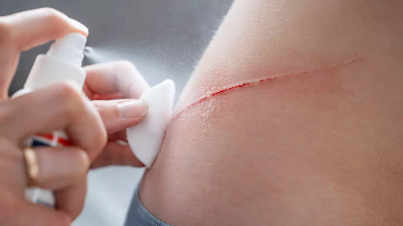 खरोंचना